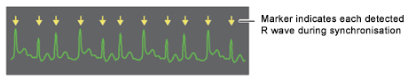 R Wave synchronisation